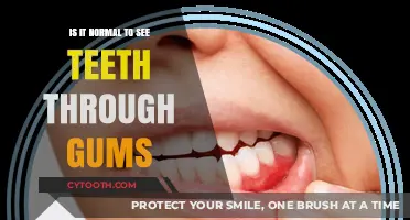 Teeth Visible Through Gums: Normal or Cause for Concern?