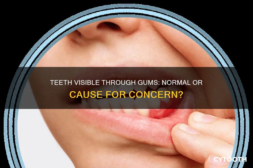 is it normal to see teeth through gums