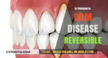 Reversing Periodontal Gum Disease: Is It Possible and How?