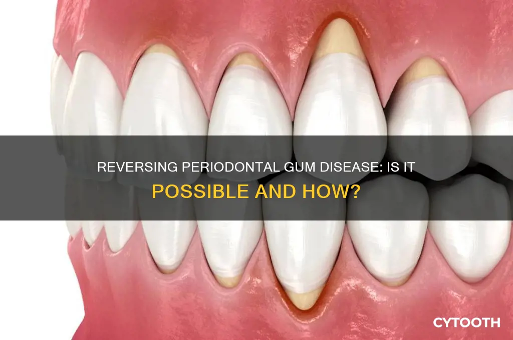 is periodontal gum disease reversible