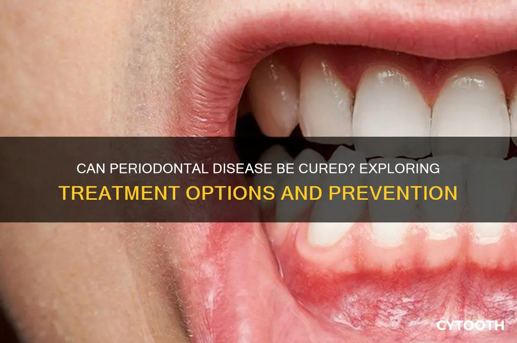 is there a cure for periodontal disease