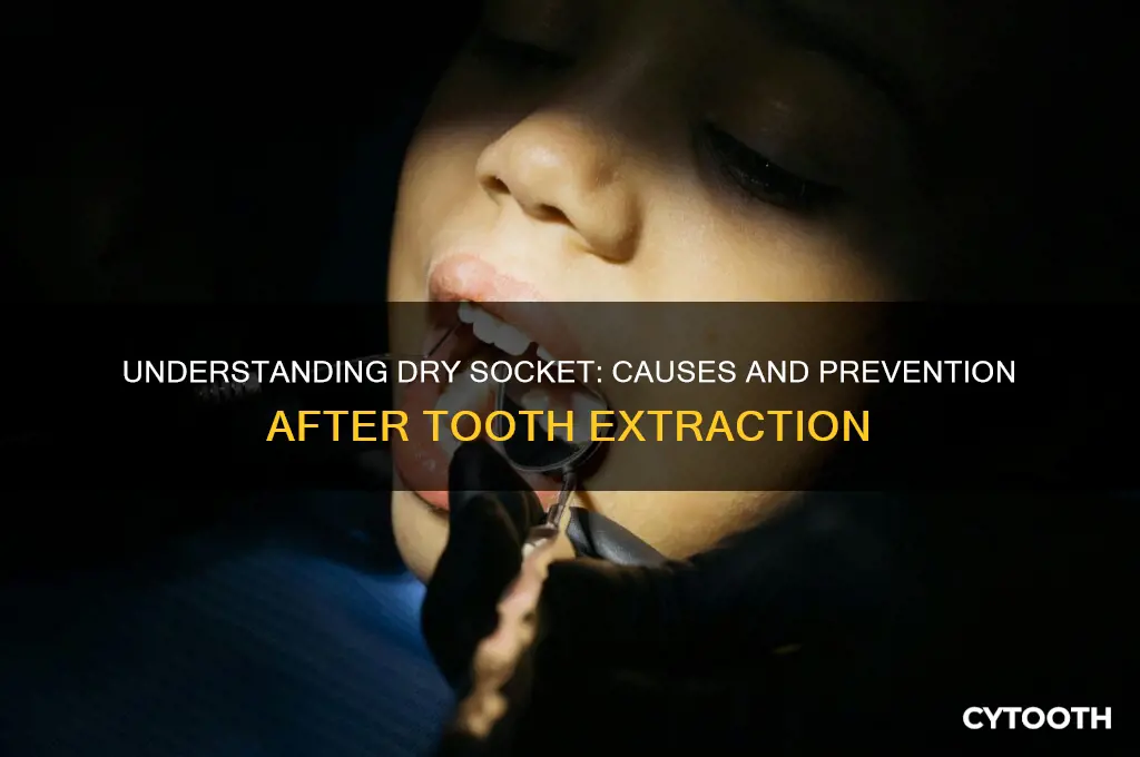 what causes a dry socket after getting a tooth pulled