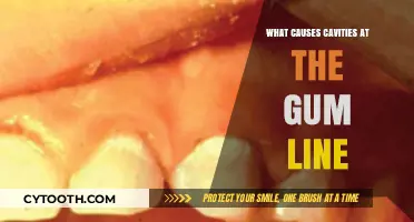 Gum Line Cavities: Causes and Prevention Tips Explained