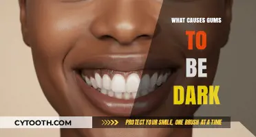 Dark Gums Explained: Causes, Concerns, and Treatment Options Revealed