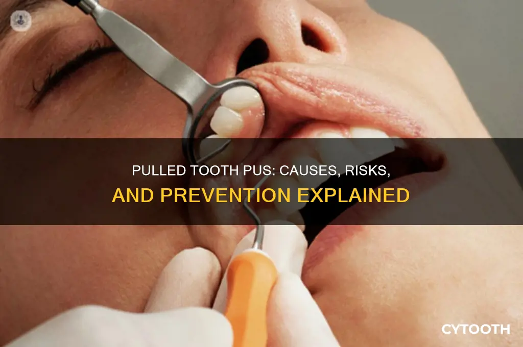 what causes pus in a pulled tooth