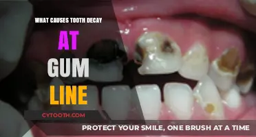 Tooth Decay at Gum Line: Causes and Prevention Tips