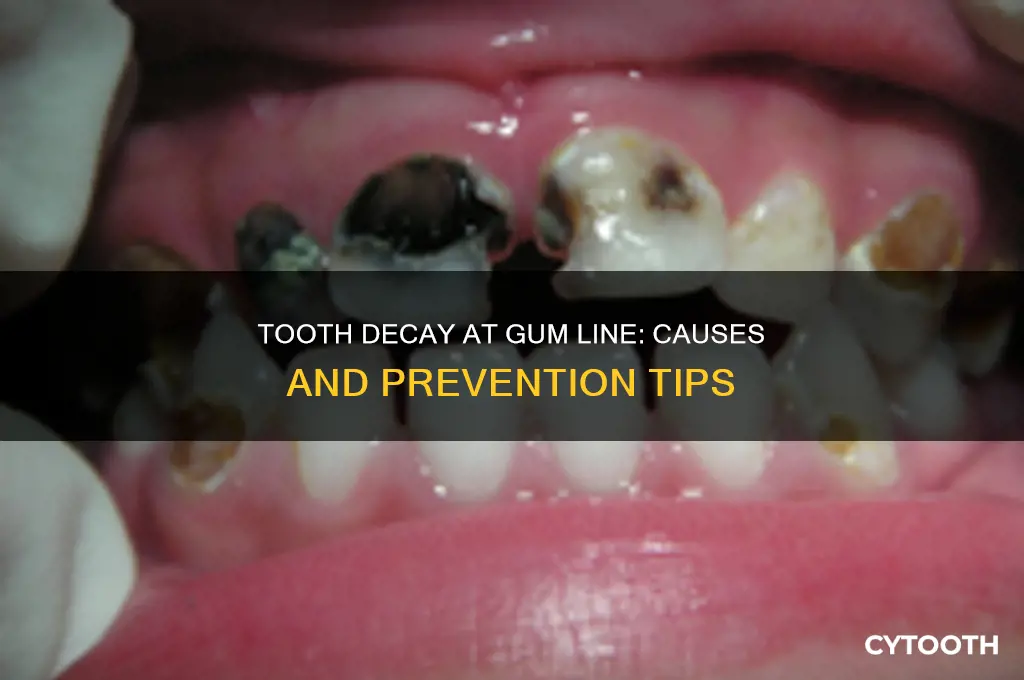 what causes tooth decay at gum line