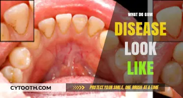 Recognizing Gum Disease: Symptoms, Appearance, and Early Warning Signs