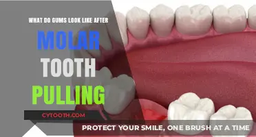 Post-Extraction Gum Appearance: What to Expect After Molar Removal