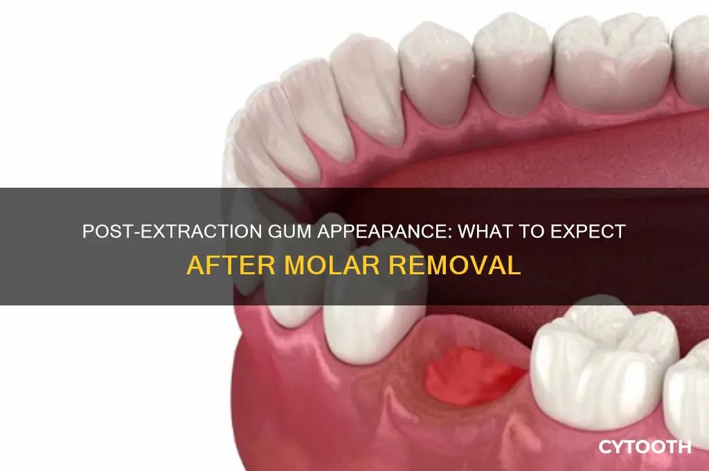 what do gums look like after molar tooth pulling