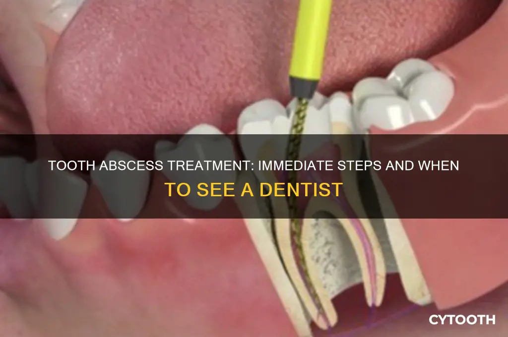 what do i do for a tooth abscess