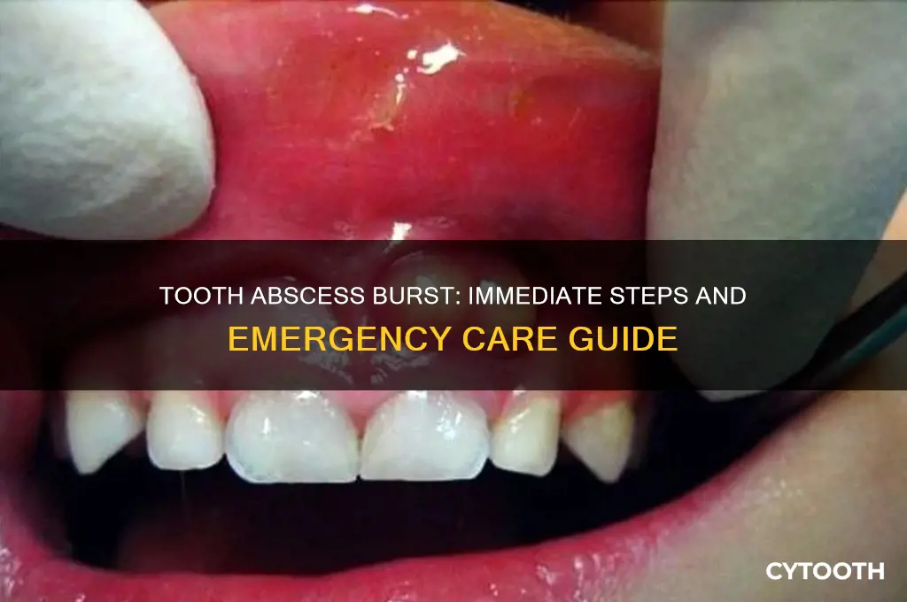 what do i do if a tooth abscess bursts