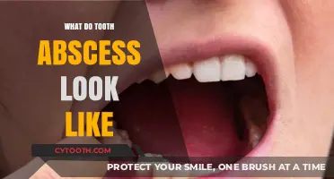 Identifying Tooth Abscess Symptoms: Visual Signs and What to Look For