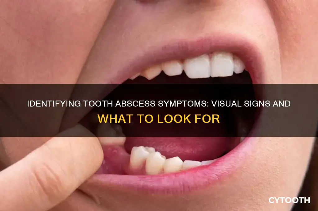 what do tooth abscess look like