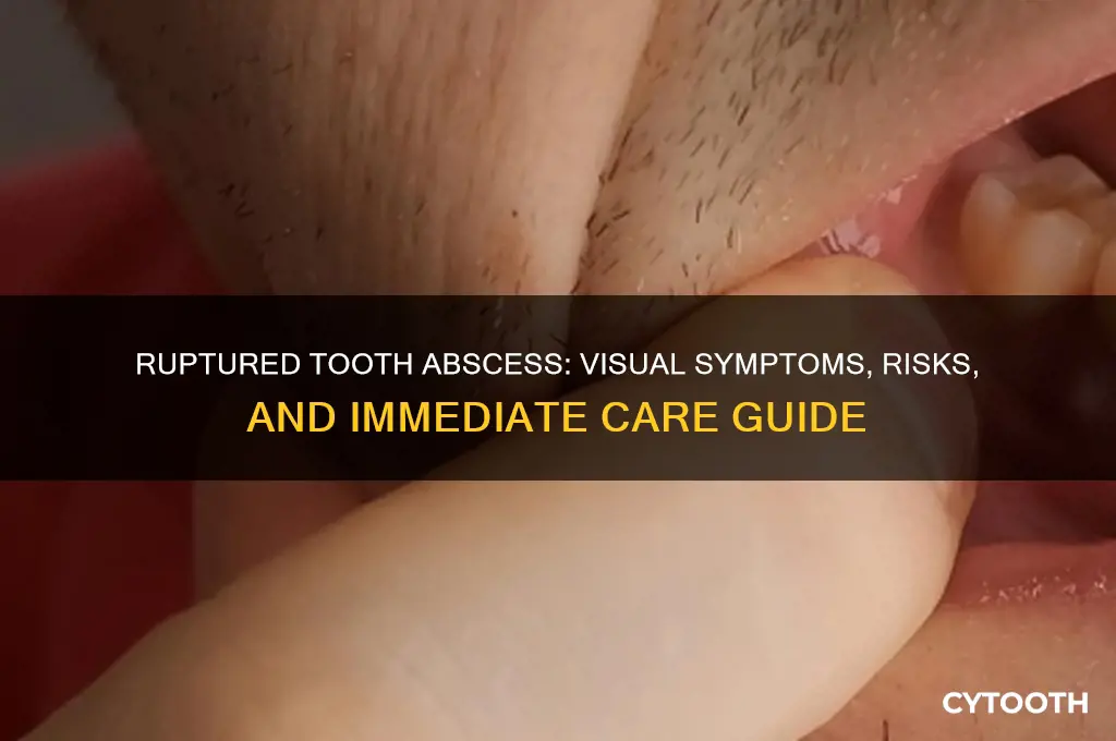what does a ruptured tooth abscess look like