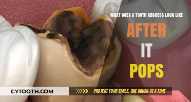 Tooth Abscess After Popping: Appearance, Symptoms, and What to Expect
