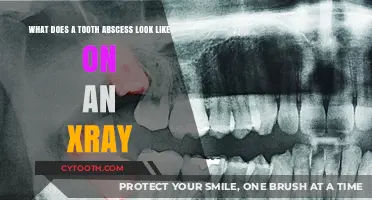Tooth Abscess on X-Ray: Visual Signs and Symptoms Explained