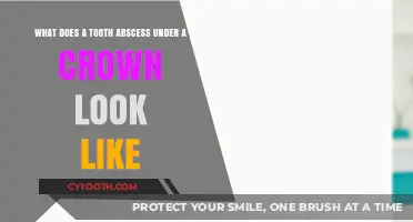 Tooth Abscess Under Crown: Symptoms, Appearance, and Treatment Options