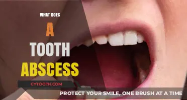 Understanding Tooth Abscess: Causes, Symptoms, and Treatment Options Explained