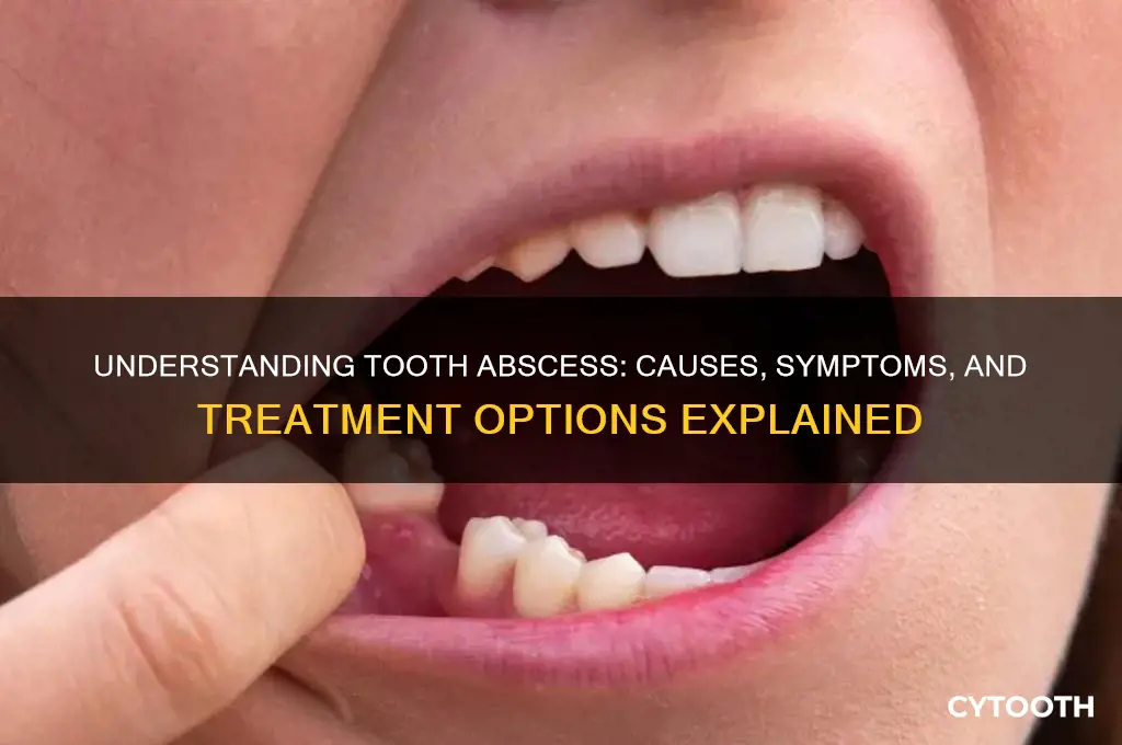 what does a tooth abscess