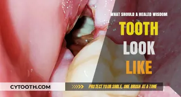 Healed Wisdom Tooth Appearance: What to Expect After Recovery