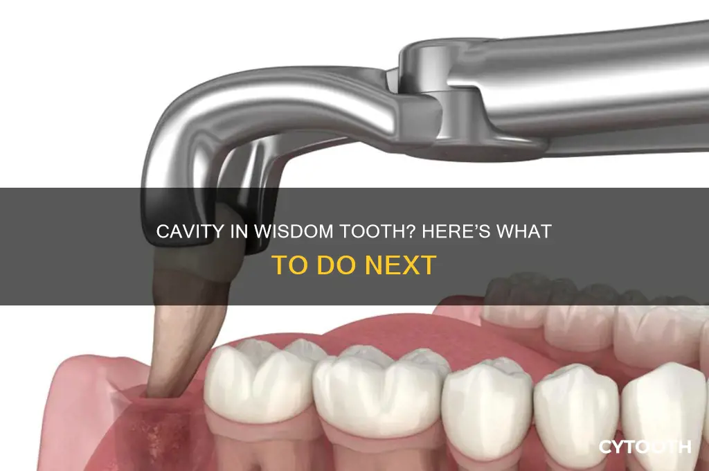 what to do if wisdom tooth has cavity