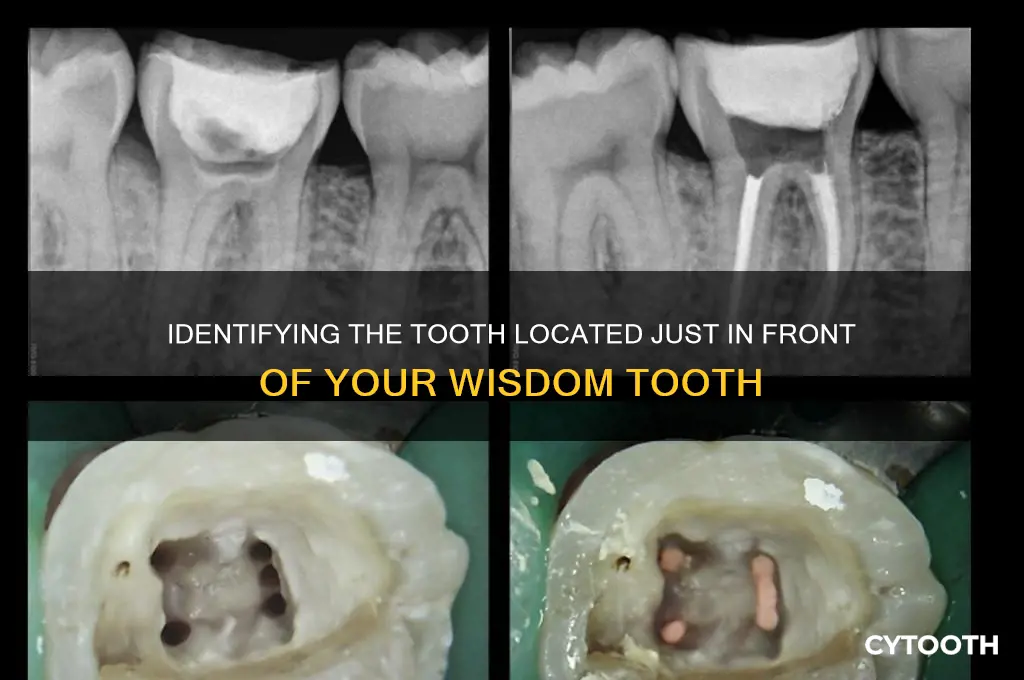 what tooth is in front of the wisdom tooth