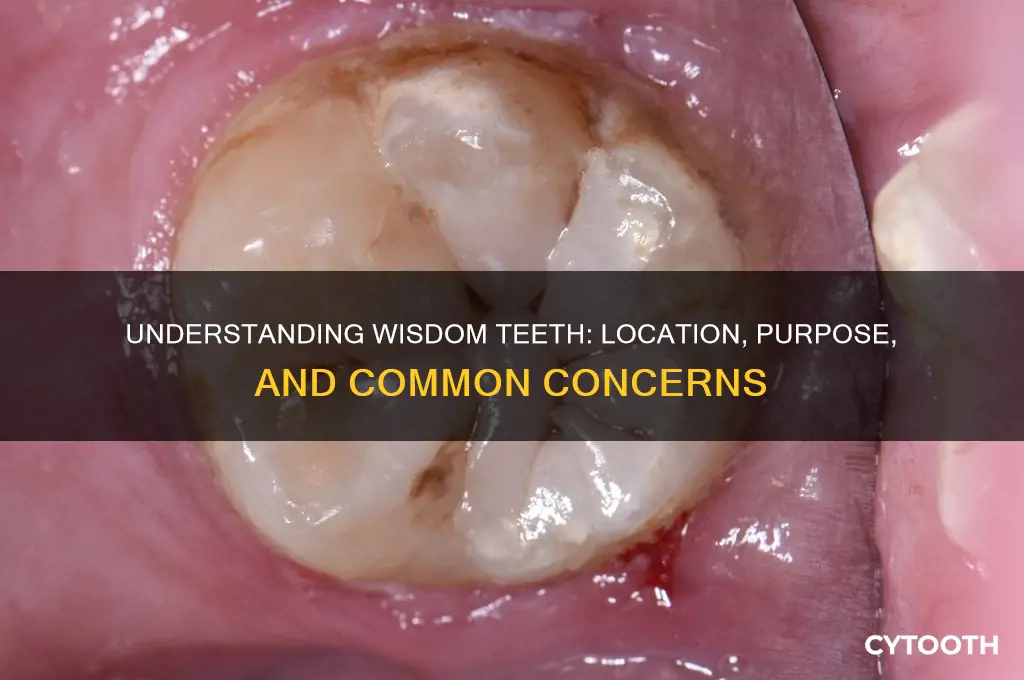 what tooth is the wisdom tooth