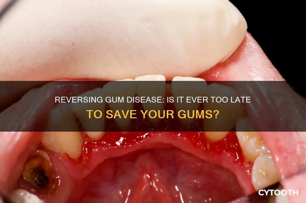 when is it too late to reverse gum disease