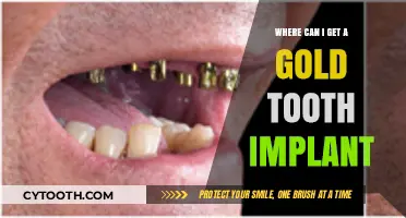 Where to Get a Gold Tooth Implant: Top Clinics and Options