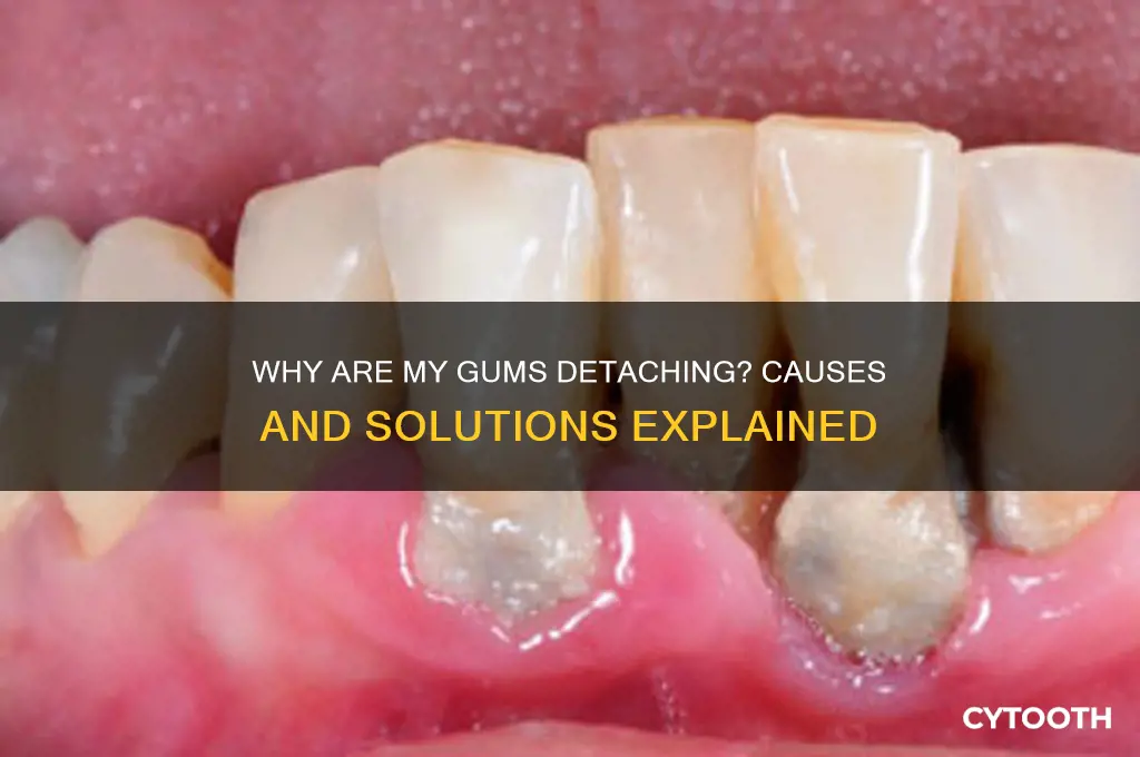 why are my gums detaching from my teeth