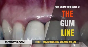 Black Teeth at Gum Line: Causes, Prevention, and Treatment Options