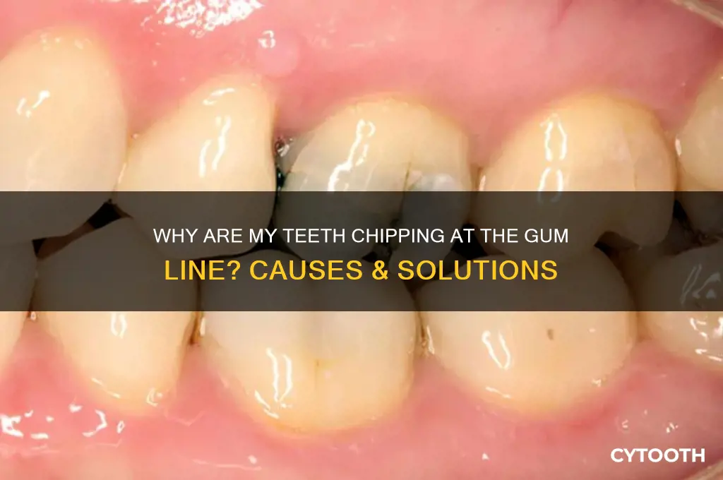 why are my teeth chipping at the gum line