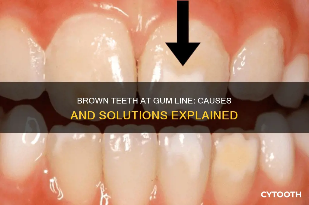 why are my teeth turning brown at the gum line
