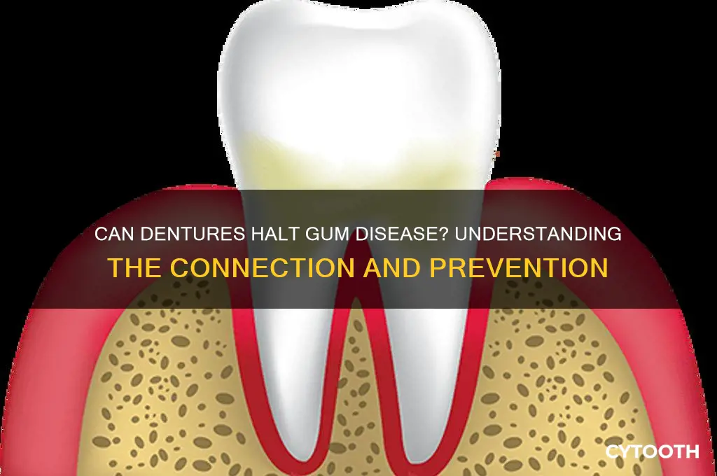will getting dentures stop gum disease