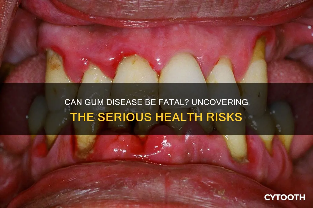 will gum disease kill you