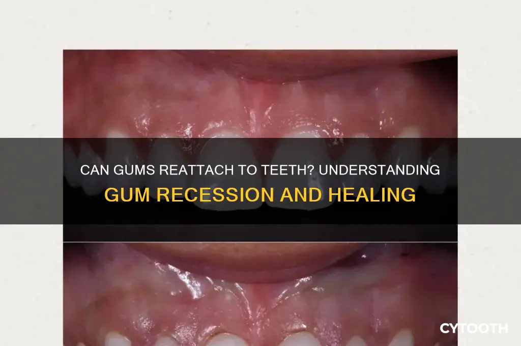 will gums reattach to teeth